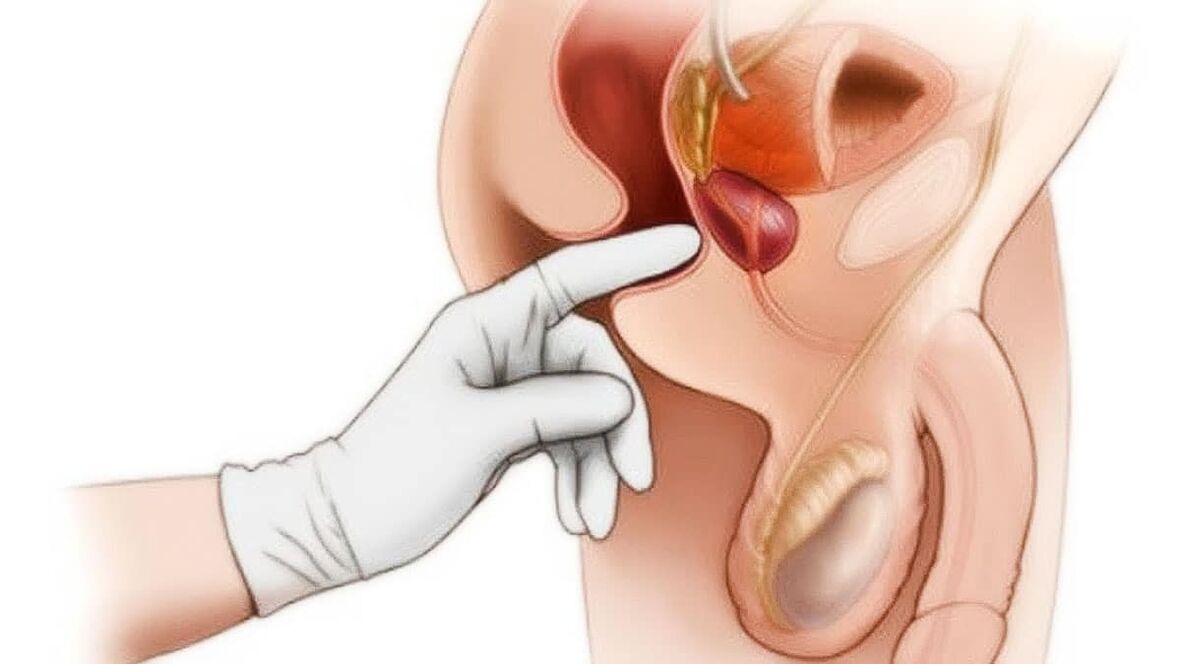 Prostatita - cauze, diagnostic și tratament