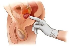 diagnosticul rectal al prostatitei