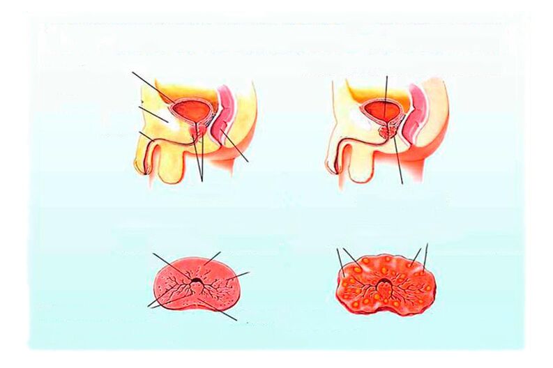 simptome de prostatită în diferite stadii